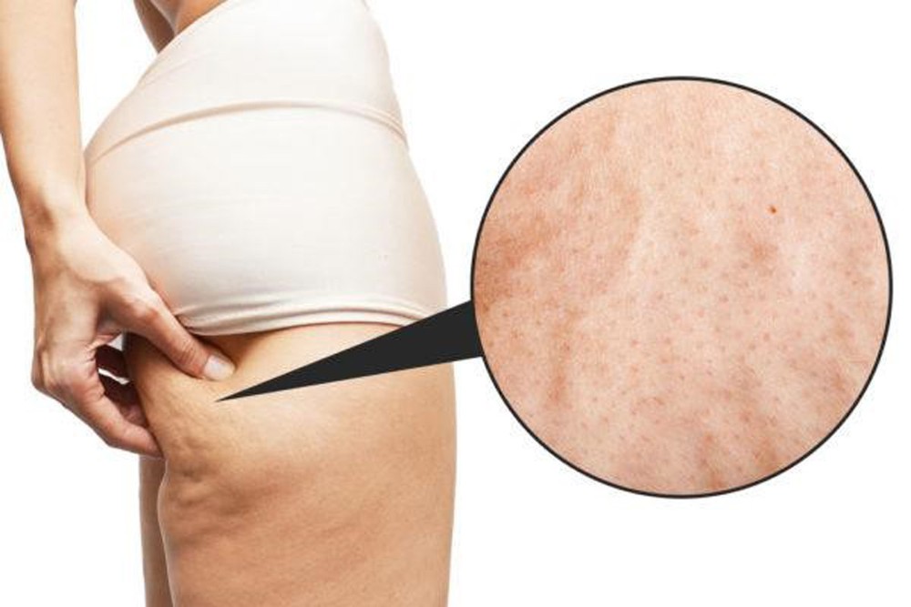 Da sần vỏ cam - Hình ảnh minh họa